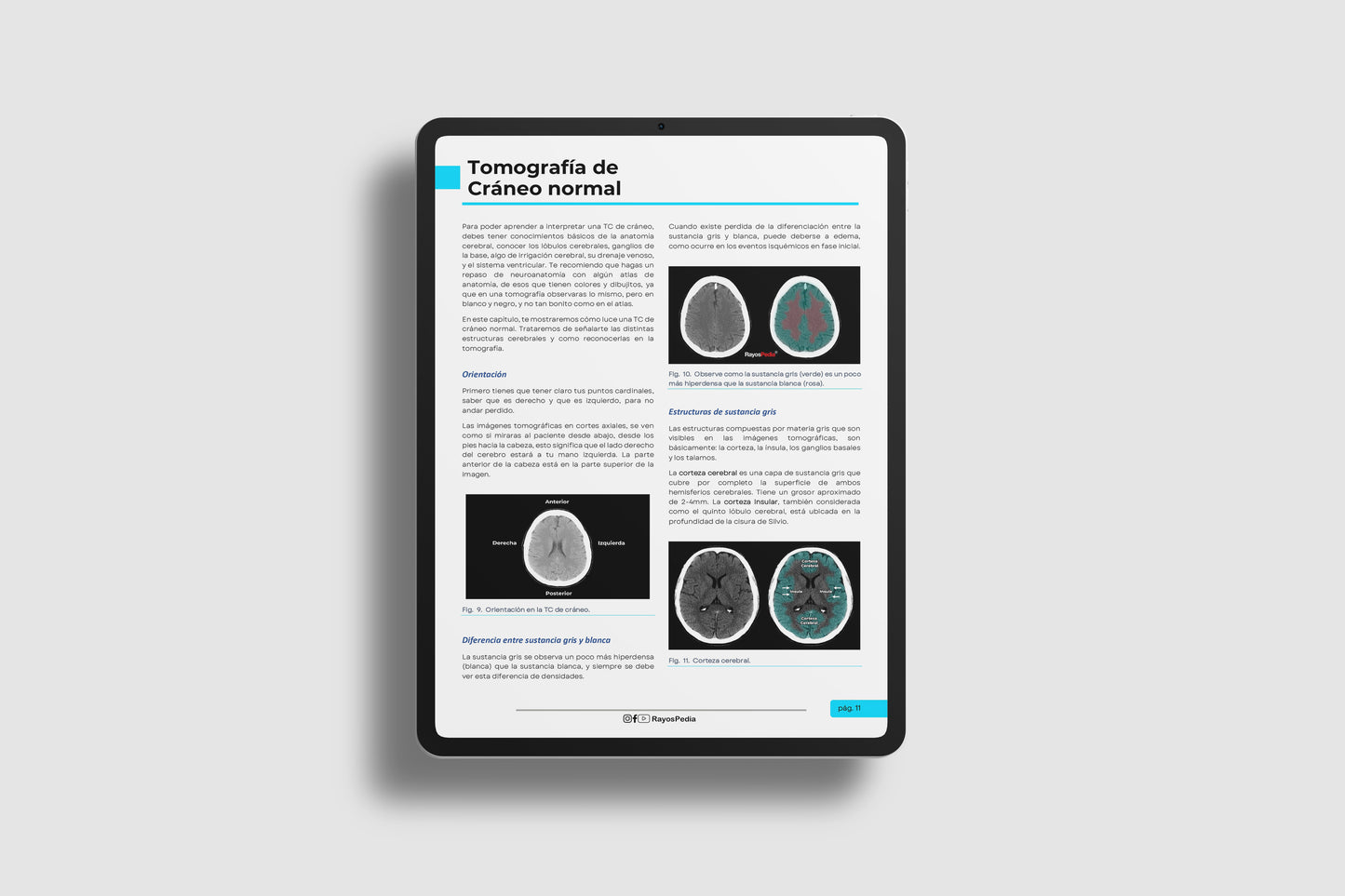 El ABC de la Tomografía de Cráneo