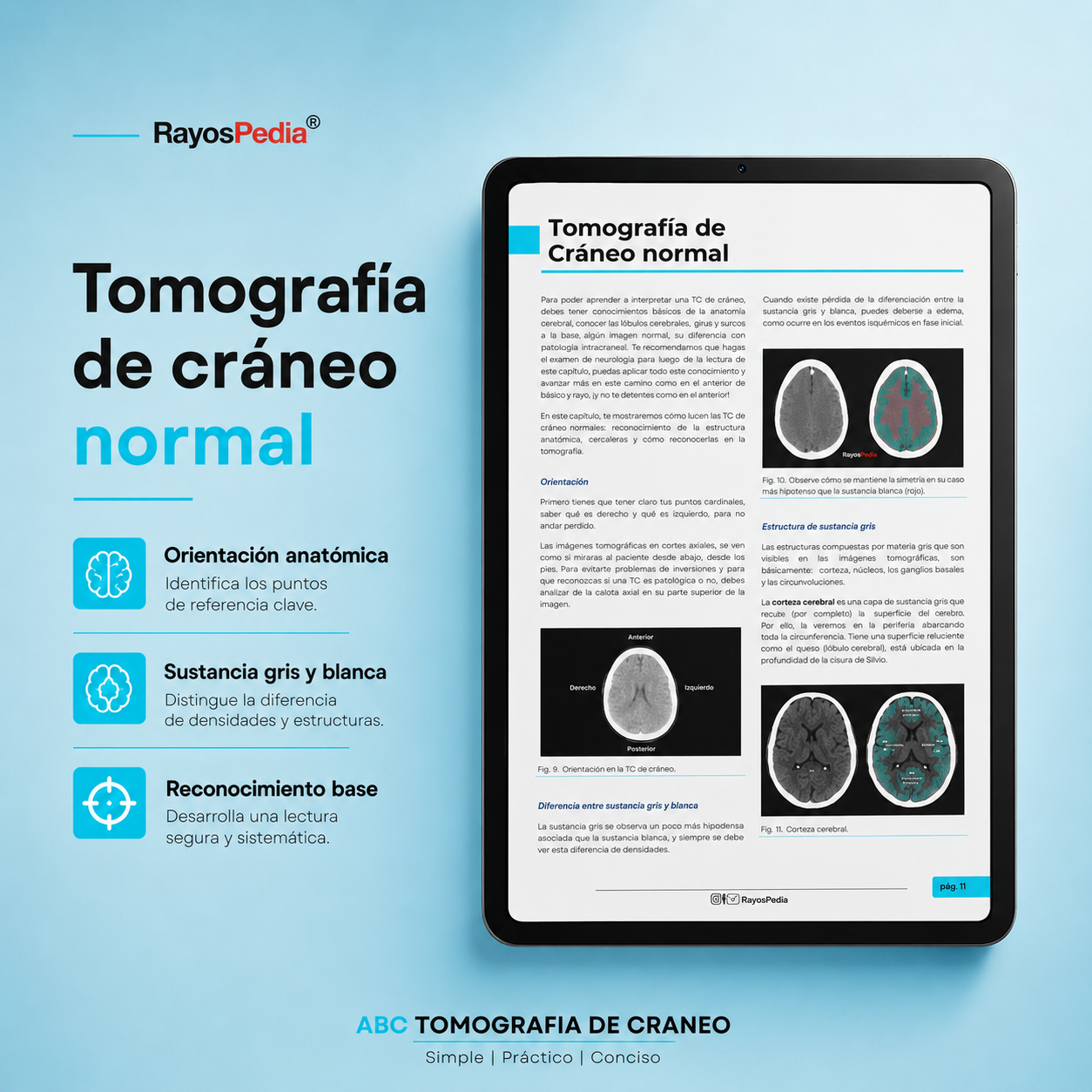 El ABC de la Tomografía de Cráneo
